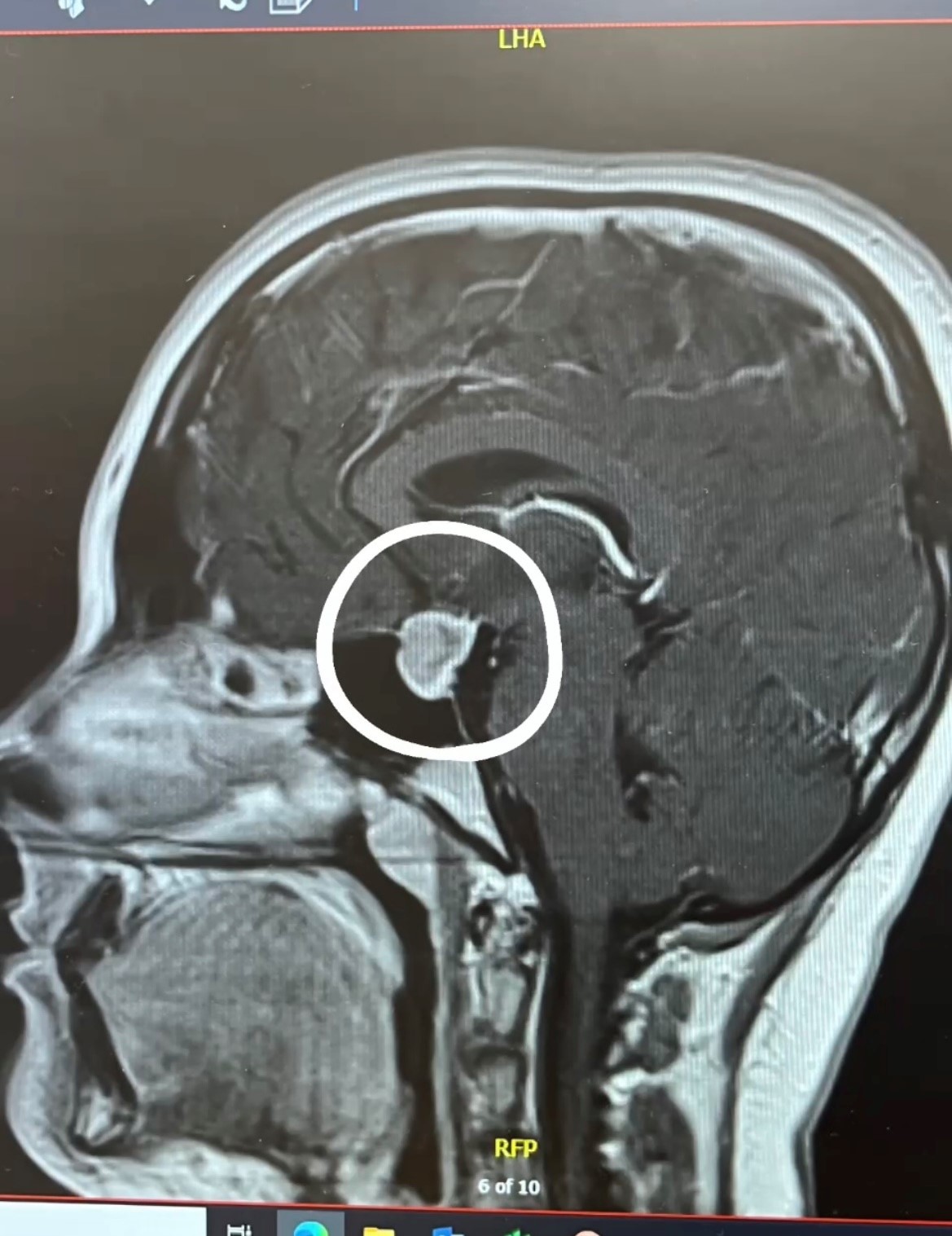 Grace s Story Macroprolactinoma Pituitary Foundation Grace s Story Macroprolactinoma Pituitary Foundation