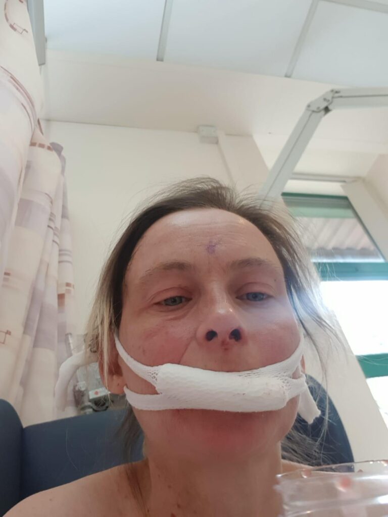 A woman in hospital, with bandages around her face after having surgery